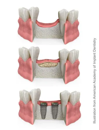 Ridge Augmentation Chevy Chase MD, Bone Grafting